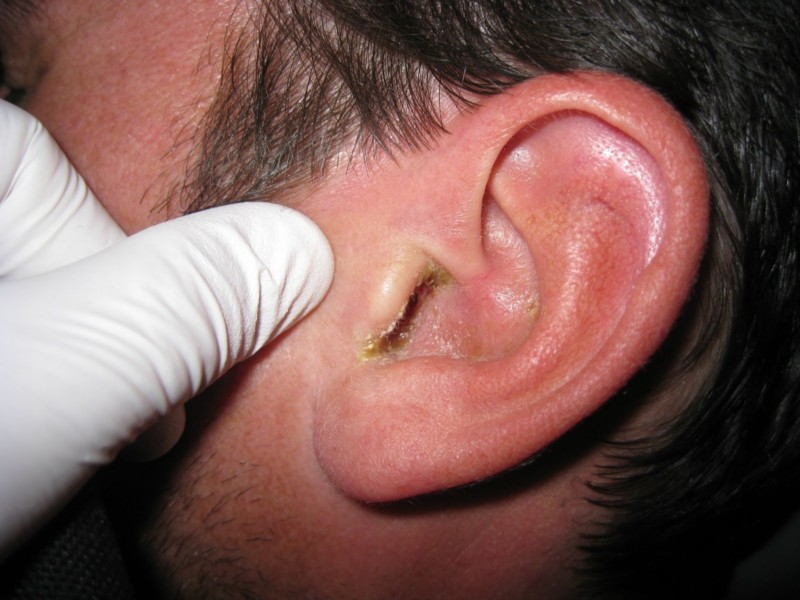 Як розпізнати і вилікувати стафілокок у вухах