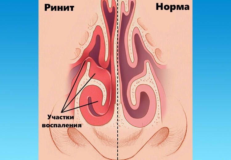 Як розпізнати і вилікувати вазомоторний риніт