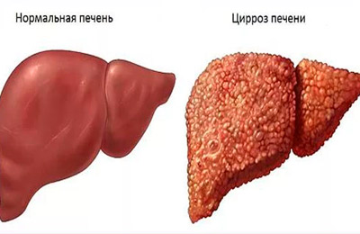 Як розводити препарат Інтерферон для носа і як його капати дорослим і дітям? Інтерферон для дітей: інструкція по застосуванню