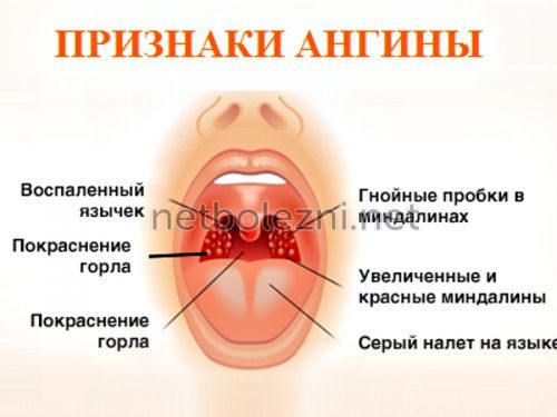 Як швидко вилікувати гнійну ангіну в домашніх умовах