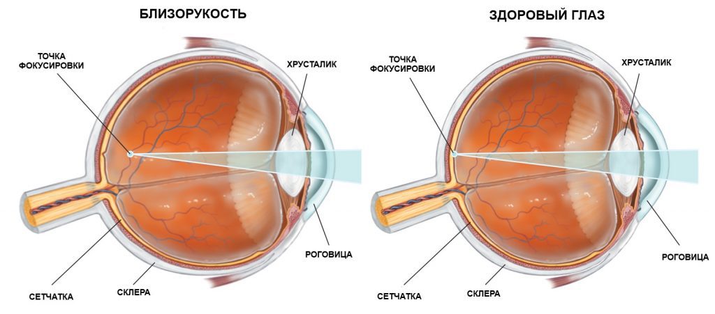Як відновити зір при короткозорості?