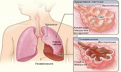 Як відрізнити бронхіт від пневмонії
