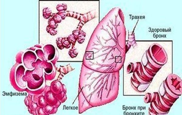 Як відрізнити бронхіт від трахеїту