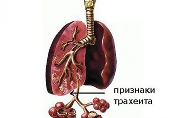 Як відрізнити бронхіт від трахеїту