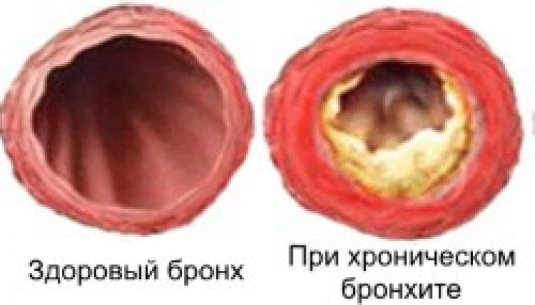 Як відрізнити бронхіт від звичайного кашлю? Як довго лікується бронхіт і чим небезпечна недуга? Як визначити що бронхіт проходить.