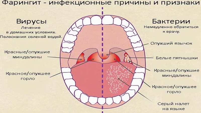 Як вибрати спрей при фарингіті