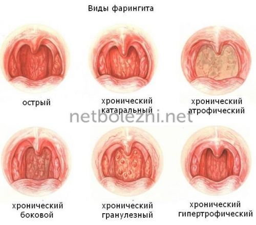 Як вибрати спрей при фарингіті