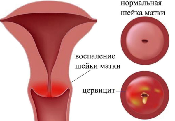 Які виділення можуть турбувати жінку при ерозії шийки матки