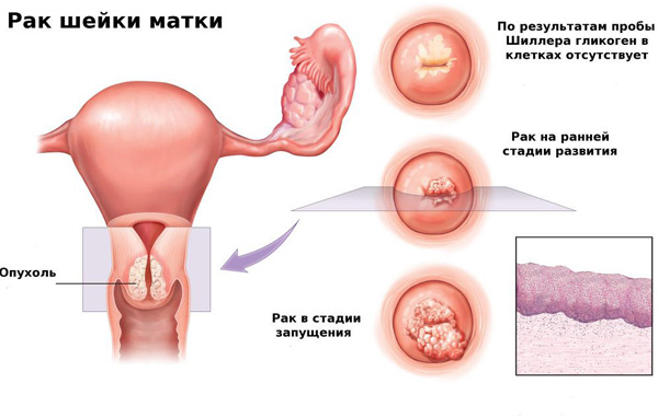 Які виділення можуть турбувати жінку при ерозії шийки матки