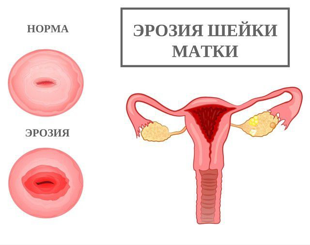 Які виділення можуть турбувати жінку при ерозії шийки матки