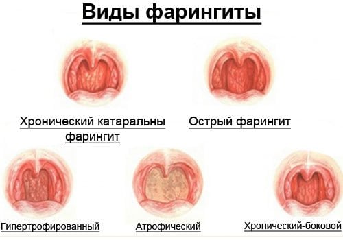 Як виглядає здорове горло – фото, відмінності від хворого горла