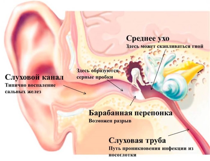 Як використовувати перекис водню від вушних пробок. Як видалити сірчану пробку з вуха перекисом водню