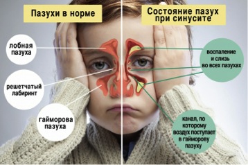 Як вилікувати двосторонній гайморит у дитини