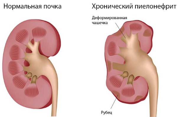 Як вилікувати фолікулярну ангіну антибіотики і не тільки