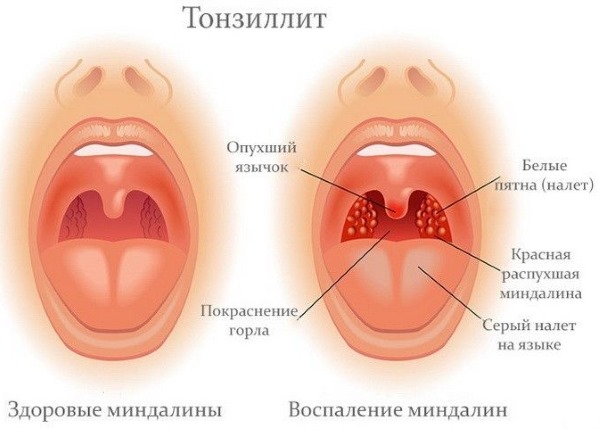 Як вилікувати фолікулярну ангіну антибіотики і не тільки