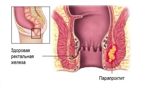 Як вилікувати геморой в домашніх умовах швидко і назавжди народними засобами, без операції