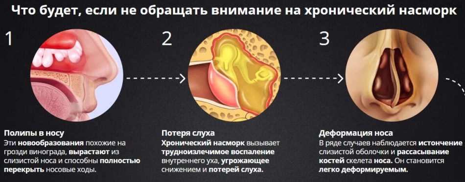 Як вилікувати хронічний нежить лікуємо хронічний нежить у дитини і в домашніх умовах