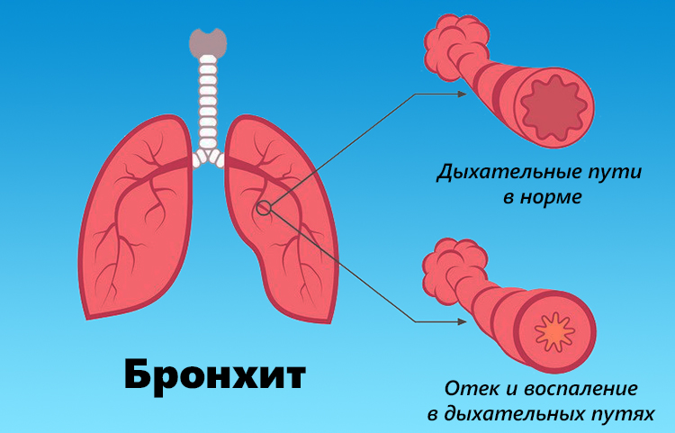 Як вилікувати нежить і кашель у дитини