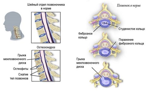 Як вилікувати остеохондроз вдома самому