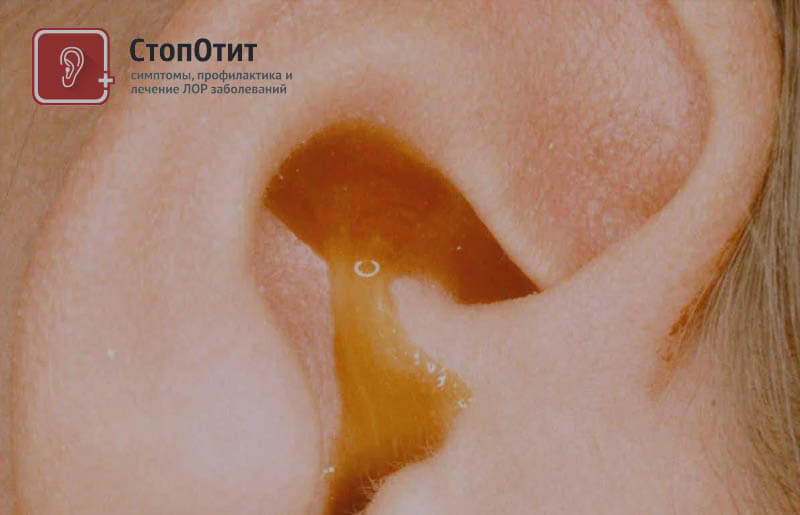 Як вилікувати отит народними засобами