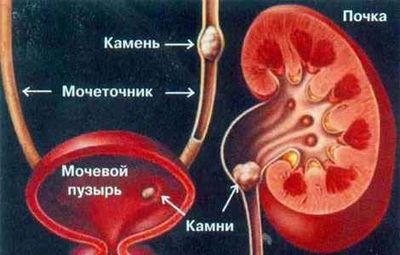 Як вилікувати сечокам’яну хворобу у людини — Лікуємо печінка