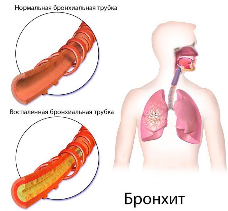 Як вилікувати золотистий стафілокок в горлі. Які симптоми, і чим лікувати золотистий стафілокок в горлі? Причини розвитку стафілококової інфекції у дітей