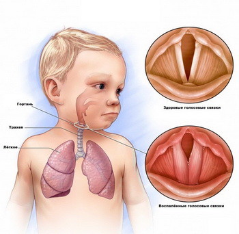 Як виявити симптоми і проводити лікування ларингіту у дітей