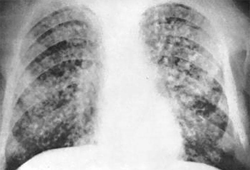 Як виявити туберкульоз легенів на ранніх стадіях