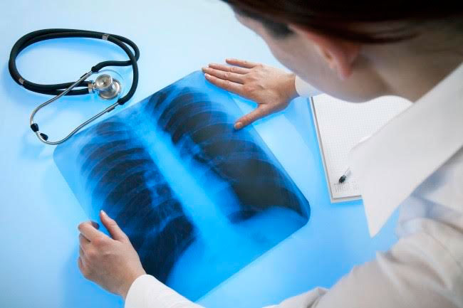 Як виявити туберкульоз легенів на ранніх стадіях