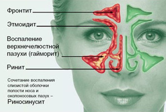 Як виявляється хронічний поліпозний риносинусит і як його лікувати Як виявляється хронічний поліпозний риносинусит і як його лікувати