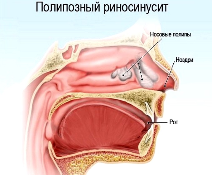 Як виявляється хронічний поліпозний риносинусит і як його лікувати Як виявляється хронічний поліпозний риносинусит і як його лікувати