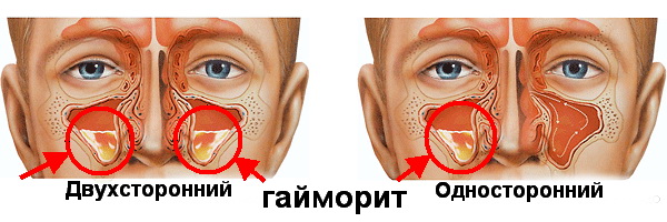 Як визначити гайморит діагностика гострої і хронічної форми