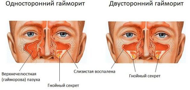 Як визначити гайморит за аналізом крові