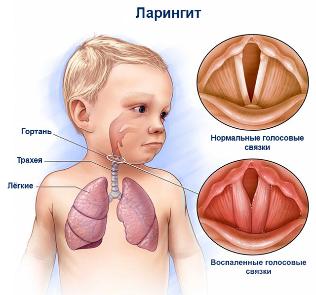 Як визначити симптоми ларингіту у дітей та вилікувати хворобу