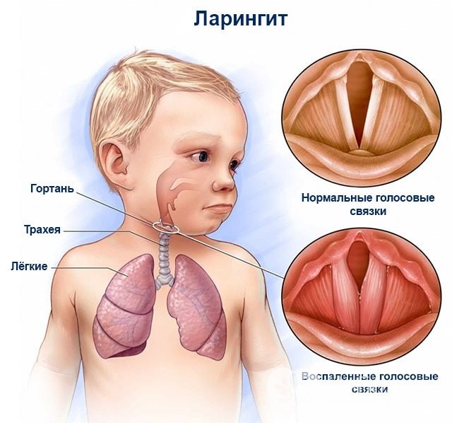Як визначити симптоми ларингіту у дітей та вилікувати хворобу