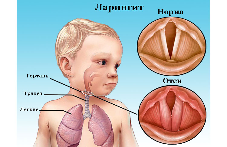 Як визначити симптоми ларингіту у дітей та вилікувати хворобу
