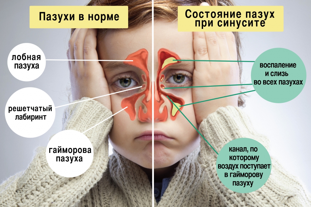 Як визначити і вилікувати гострий синусит