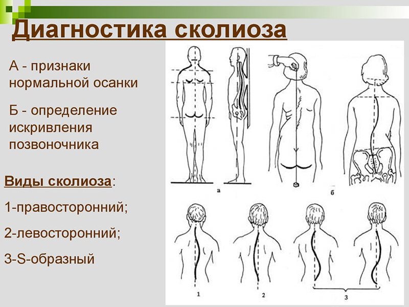 Які вправи потрібно робити при сколіозі