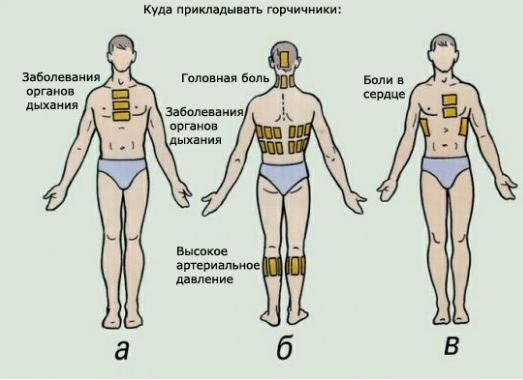 Як застосовувати гірчичники при сухому кашлі