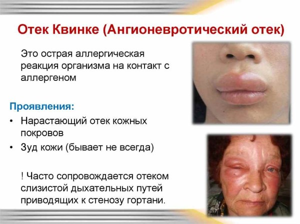 Як застосовувати Малаві при вагітності? Малаві: властивості, призначення та застосування при вагітності