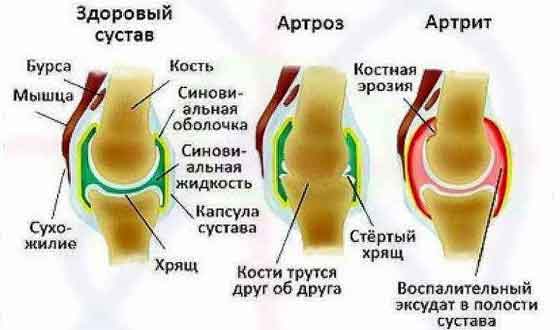 Як зняти біль при артрозі колінного суглоба