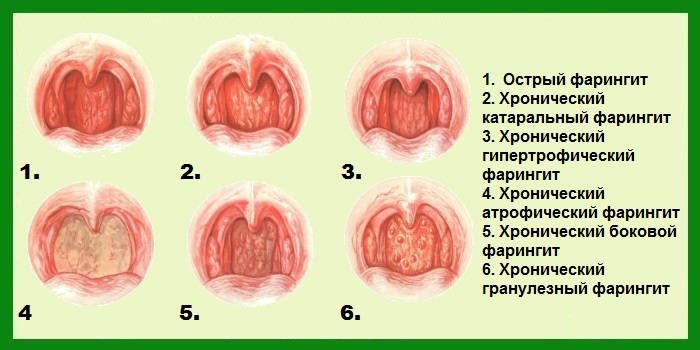 Як зрозуміти, що болить горло у немовляти і чим лікувати