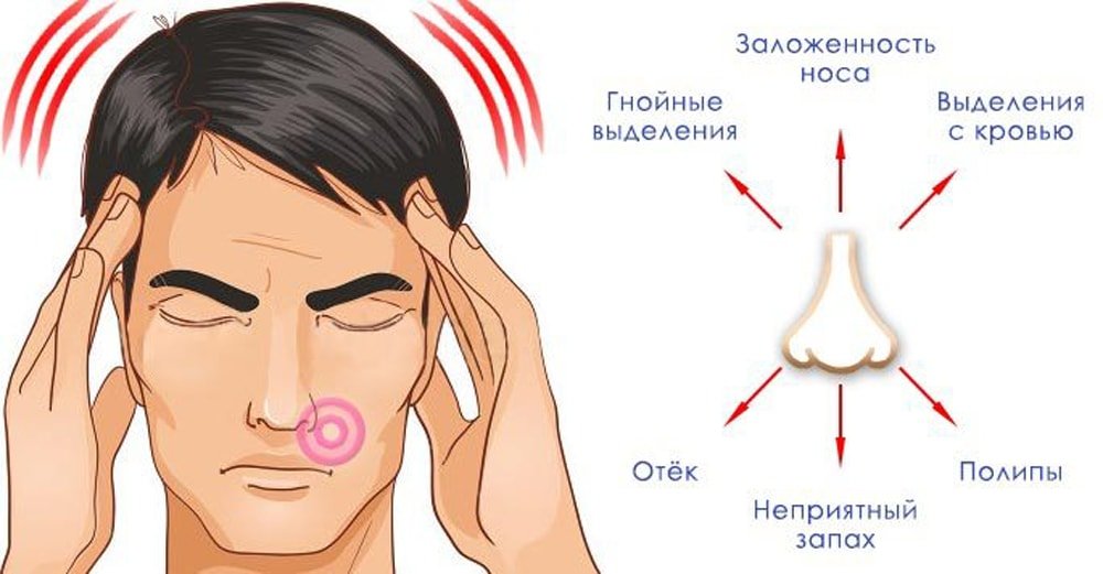 Як зрозуміти що гайморит перейшов у менінгіт