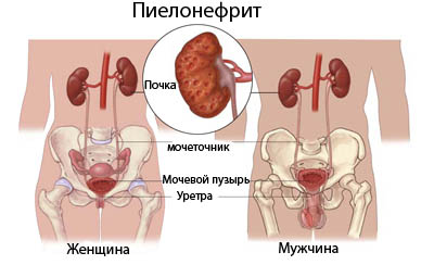 Якими антибіотиками лікувати пієлонефрит