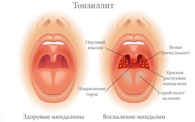 Який антибіотик при ангіні можна давати дітям
