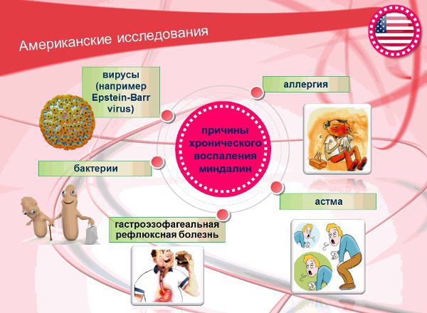Загострення хронічного тонзиліту симптоми і лікування Загострення хронічного тонзиліту симптоми і лікування