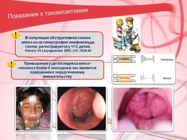 Загострення хронічного тонзиліту симптоми і лікування Загострення хронічного тонзиліту симптоми і лікування