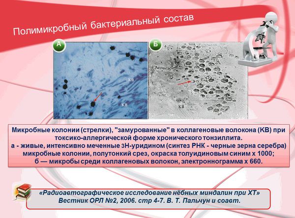 Загострення хронічного тонзиліту симптоми і лікування Загострення хронічного тонзиліту симптоми і лікування
