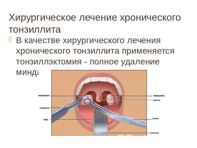 Загострення тонзиліту – як лікувати і що приймати