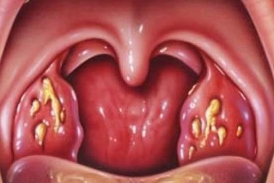 Загострення тонзиліту – як лікувати і що приймати